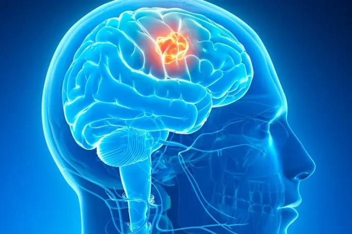 Scientists have discovered how brain tumors use fructose metabolism to evade the immune system and attack